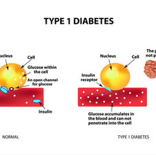 Type 1 Diabetes