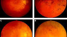 Novel mutations of RPGR in Chinese families with X-linked retinitis pigmentosa