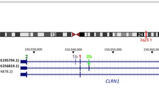 A mutation in CLRN1 underlies severe Usher Syndrome on Arabian Peninsula 