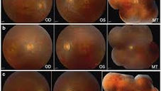 Mutation K42E in dehydrodolichol diphosphate synthase (DHDDS) causes recessive retinitis pigmentosa