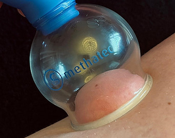 Cupping.jpg