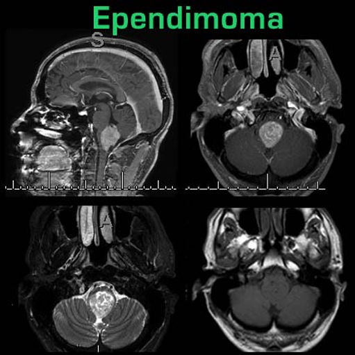 Ependimoma