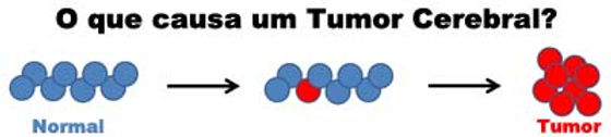 O que causa um tumor cerebral