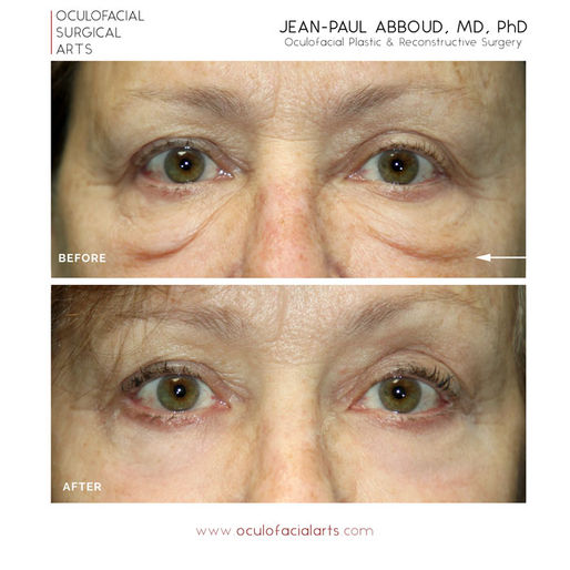 Understanding Festoons: Causes, Treatments, and Success Stories