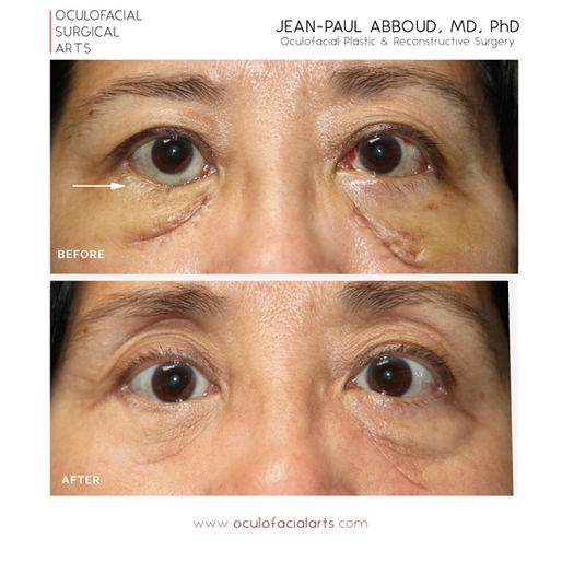 The Power of 5-Fluorouracil (5-FU) in Aesthetic Medicine: Reducing Scar Tissue for Improved Outcomes