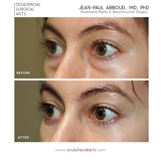 before-and-after lower eyelid blepharoplasty