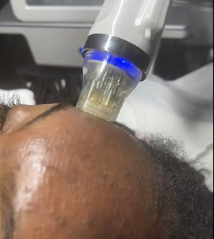 RfMicroneedling.jpeg