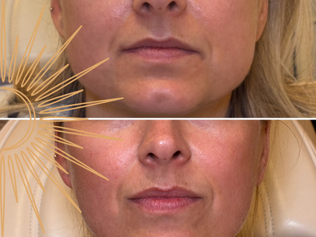 Can Botox Soften Jowls and Refine the Jawline?