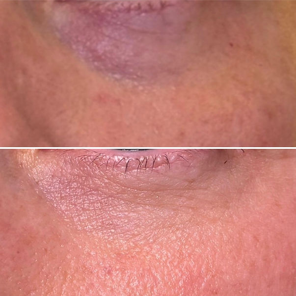 Under eye collagen regeneration