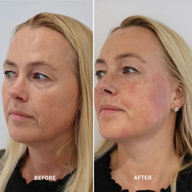 Full face Juvelook Before and After