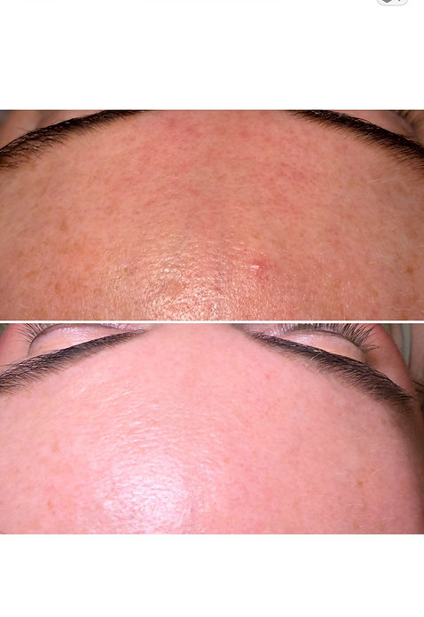 pore shrinking microneedling