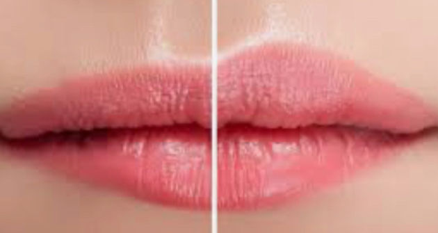 Botox lip flip barnes london