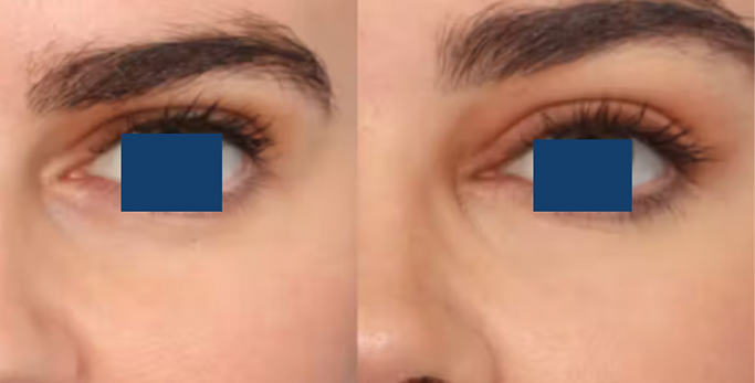 botox brow lift Barnes london