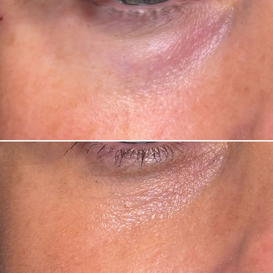 Juvelook Before and After