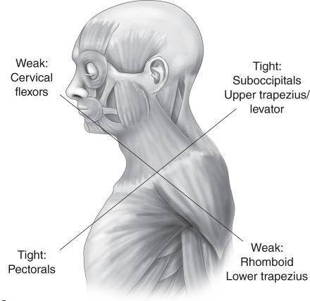 Upper Crossed Syndrome