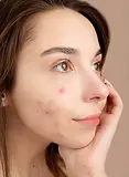 Nodular Acne: A Comprehensive Guide