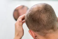 Scalp acne: Causes and Treatments