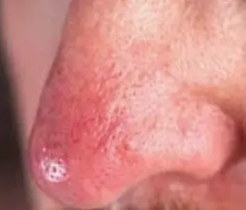 Redness Around Nose