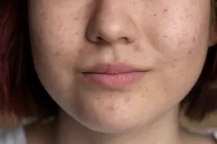Hormonal Acne: How Hormones and Microbiome Affect Your Skin