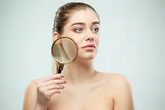 How to Get Rid of Acne Scars?