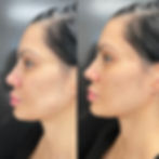 Nina Unrated's Side profile before and after facial PRP skin treatment