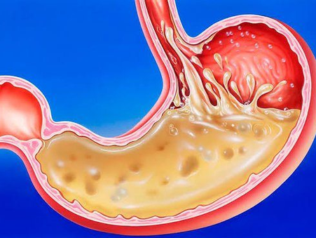 Understanding Stomach Health: How Bacteria, Candida, and pH Imbalance Affect Digestion