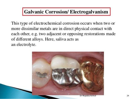 Understanding the Oral Galvanic Effect: How Mixed Metals Impact Your Body