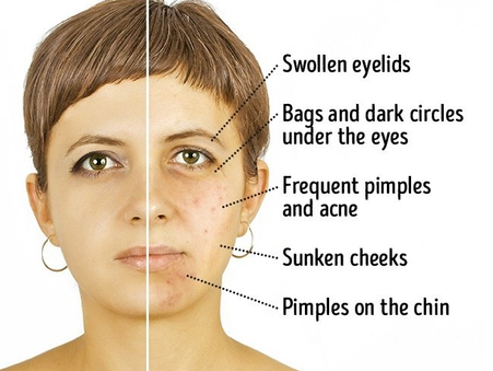Dairy Face: How Dairy Consumption May Be Affecting Your Skin