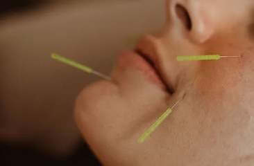 facial acupuncture session for anti-aging and enhancing skin rejuvenation naturally