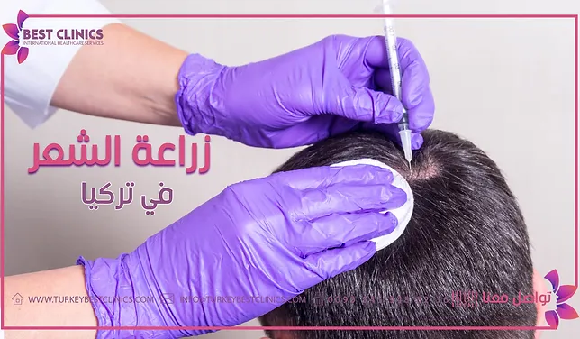 زراعة الشعر في تركيا turkey best clinics