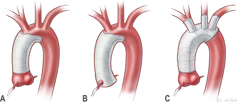 There are different options for repairing a TAAD. Your surgeon will choose the best method for you depending on the size of the dissection and the structures involved. Source: Heuts S, Schalla S, Ramaekers MJFG, et al. Imaging surveillance for complications after primary surgery for type A aortic dissection. Heart 2023;109:96-101.