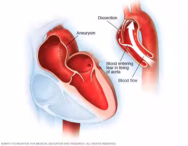 A Type A dissection involves the region of the aorta that attaches directly to the heart. Dissections in this region can quickly progress through the aorta and affect blood flow to the heart, brain, and arms.        Source: https://www.mayoclinic.org/diseases-conditions/aortic-dissection/symptoms-causes/syc-20369496