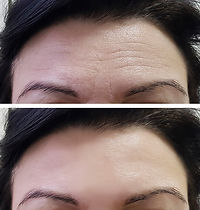 before after forehead.jpg