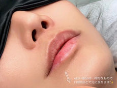 ローマピンク★リップ施術直後