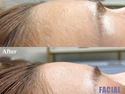 フェイシャルワックスでつるんとおでこに⭐️