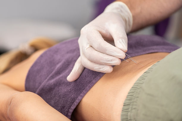 Physical therapist performing dry needling on a patient's lower back to relieve muscle pai