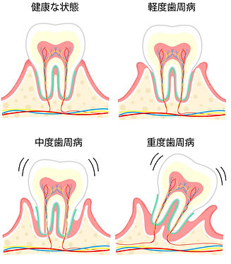 歯周病