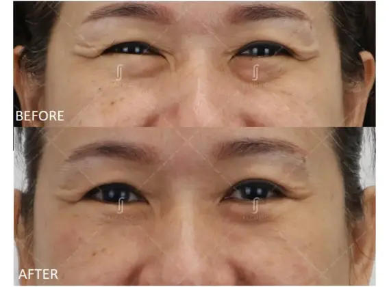 Eye bag surgery result in older patient with loose skin