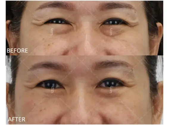 Eye bag surgery result in older patient with loose skin
