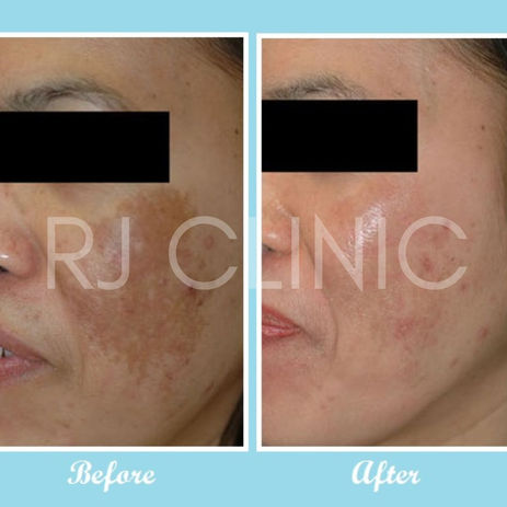 Rawatan melasma sebelum selepas di klinik RJ 2