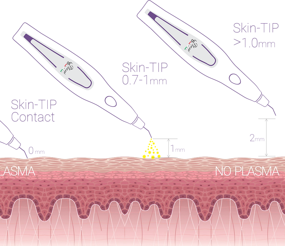 Plexr Plasma Laser Eyelift | RJ CLINIC