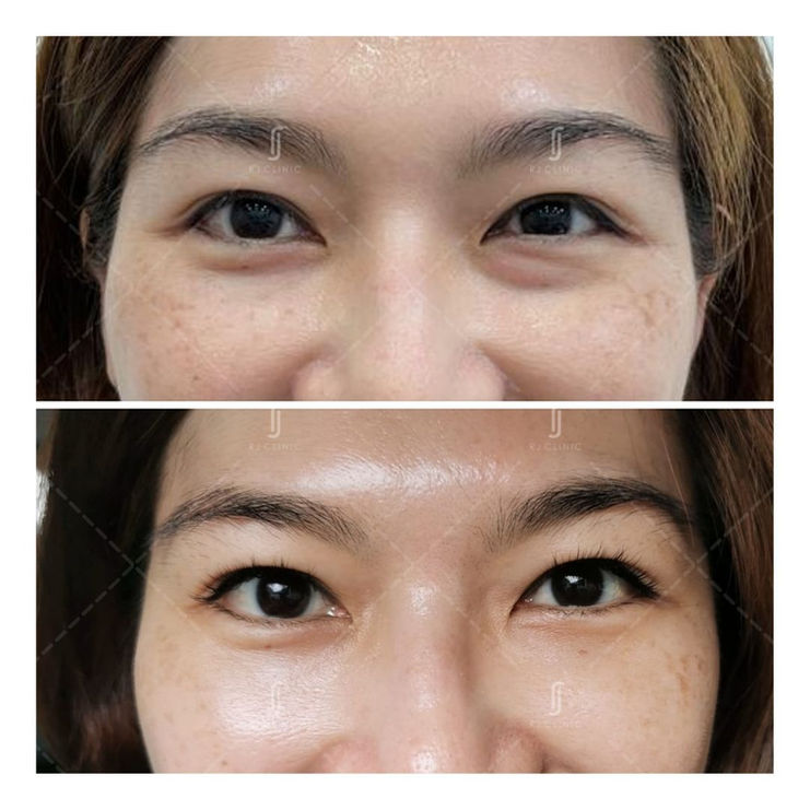 Laser Eyebag Removal Kl