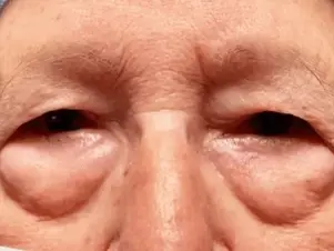 Cara Menghilangkan Eyebag dengan Cepat