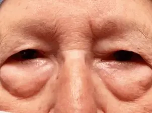 Cara Menghilangkan Eyebag dengan Cepat