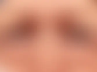 Cara Menghilangkan Eyebag dengan Cepat