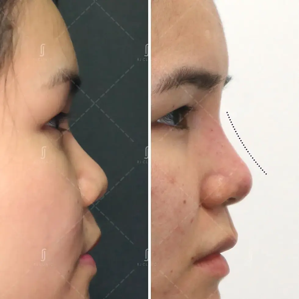 Non-surgical nose job resultat RJ Clinic