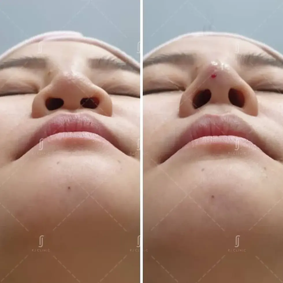 Nose filler RJ Clinic Malaysia before and after results