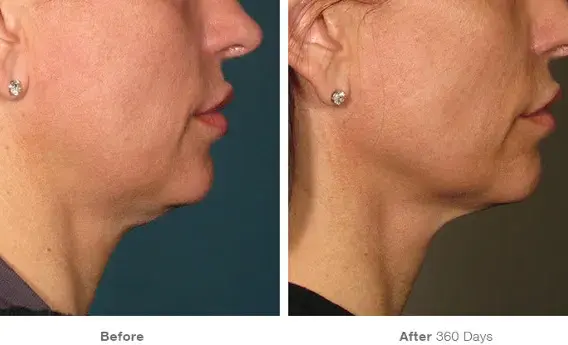 Tightened face without surgery – Ultherapy Prime Malaysia