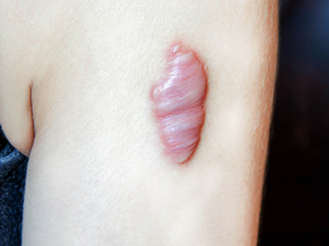 Keloids on arm