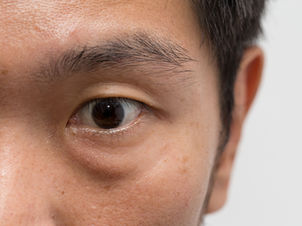 Under-Eye Bags: Busting Myths and Aesthetic Treatment Options